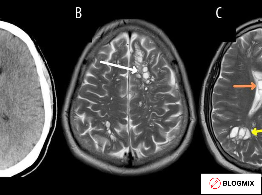 Merinding! Sederet Kasus Cacing Pita Bersarang di Tubuh Manusia, Perut hingga Otak